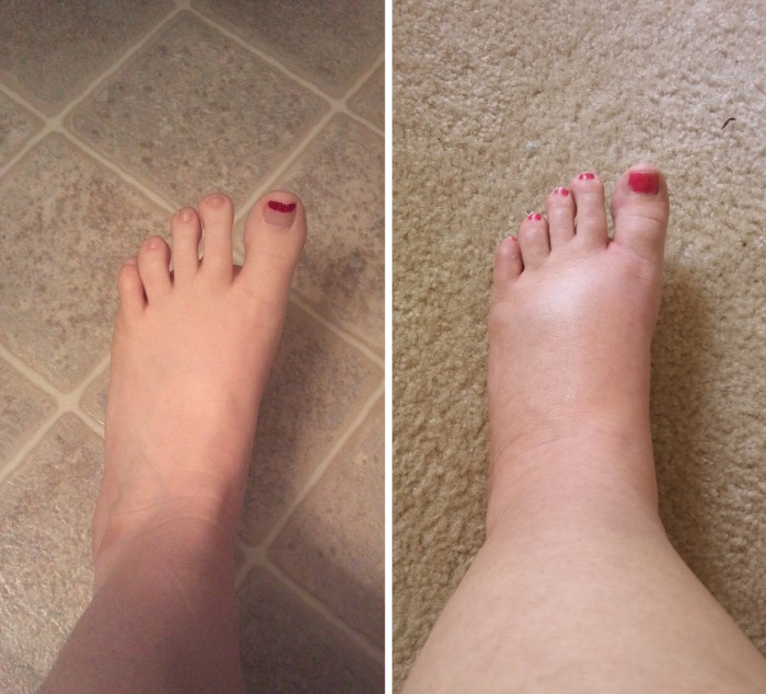 What To Do When Pregnant With Swollen Feet